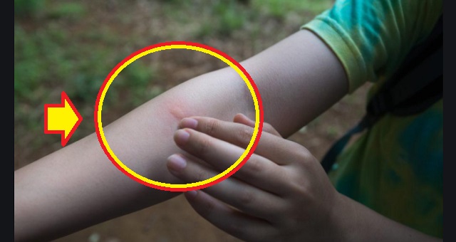【神業】去年虫に刺されまくった娘が『あること』をするだけでマジで蚊に刺されなくなった！